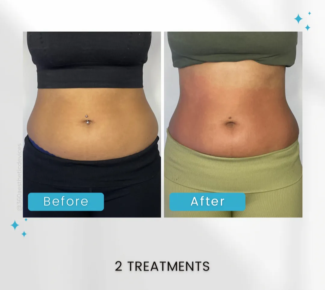 CRYOCORE SCULPT