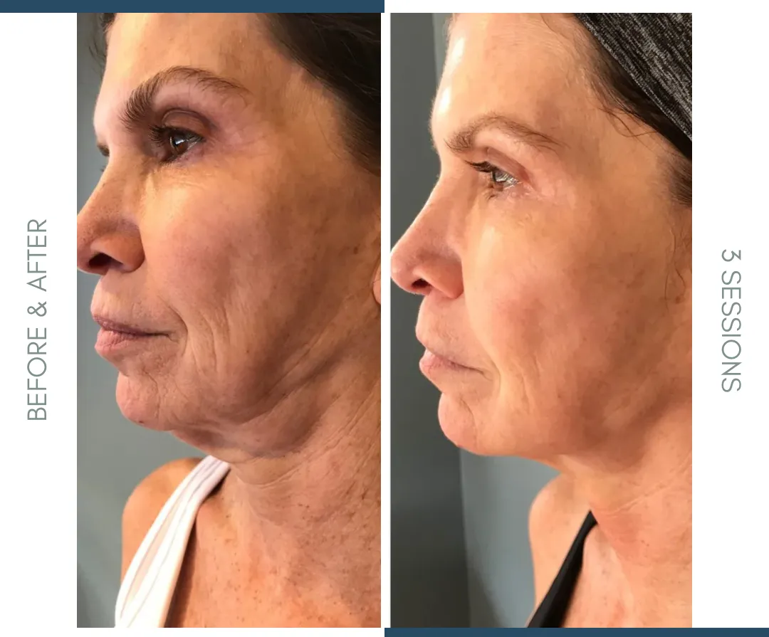 FACE & NECK LYFT FACIAL