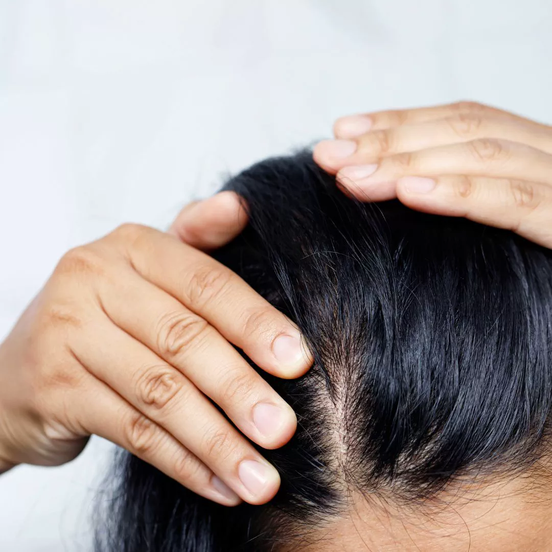 HAIR RESTORATION