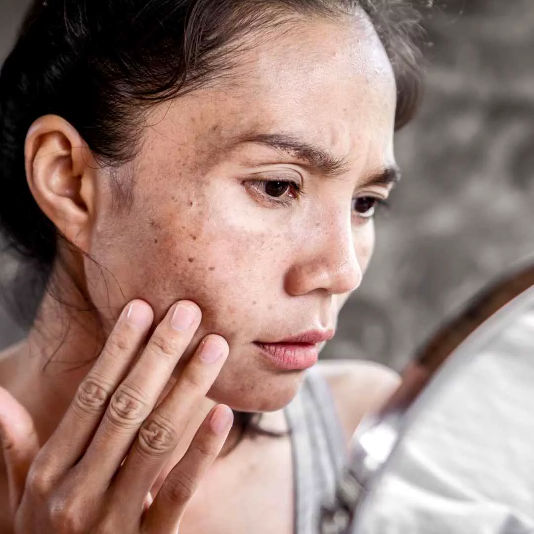 HYPERPIGMENTATION