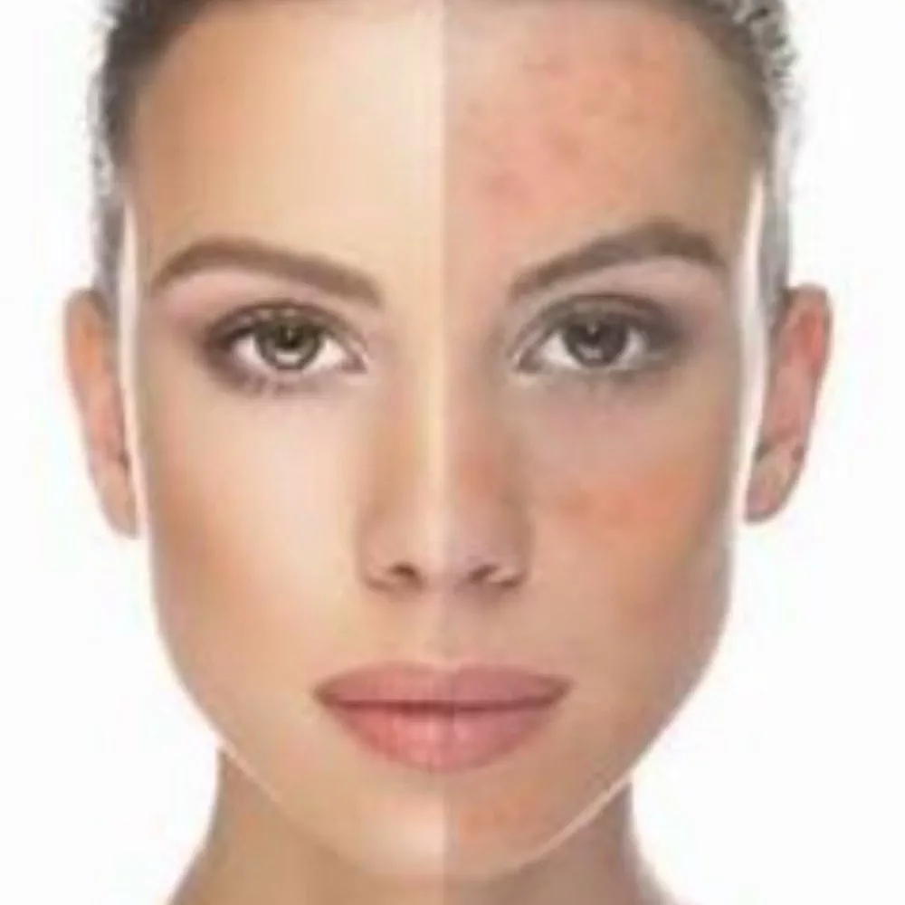 Clearskin Calming Acne Facial