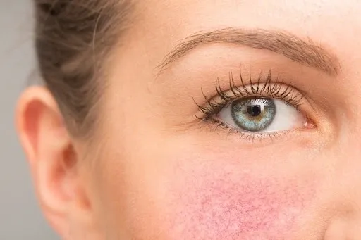 Rosacea Sensitive Skin