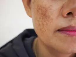 Sun damage Therapy