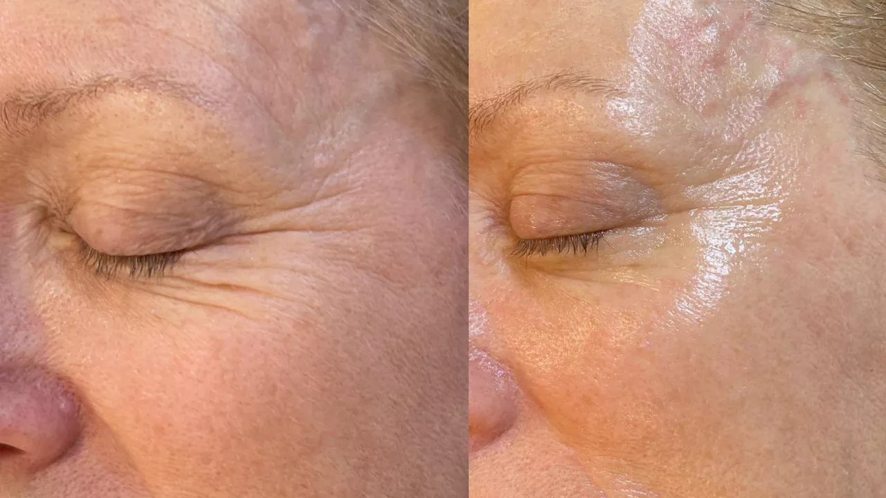 Beyond Botox Facial